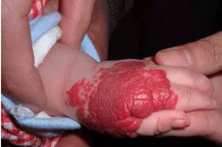 新生儿红色血管瘤图片图片