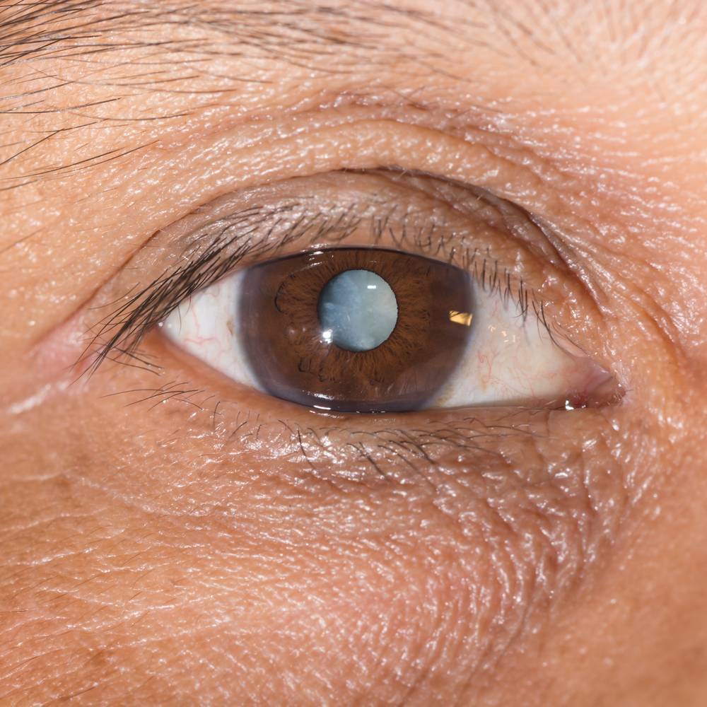 白内障是糖尿病眼部并发症的一种,尤其是在中老年糖尿病患者身上比较