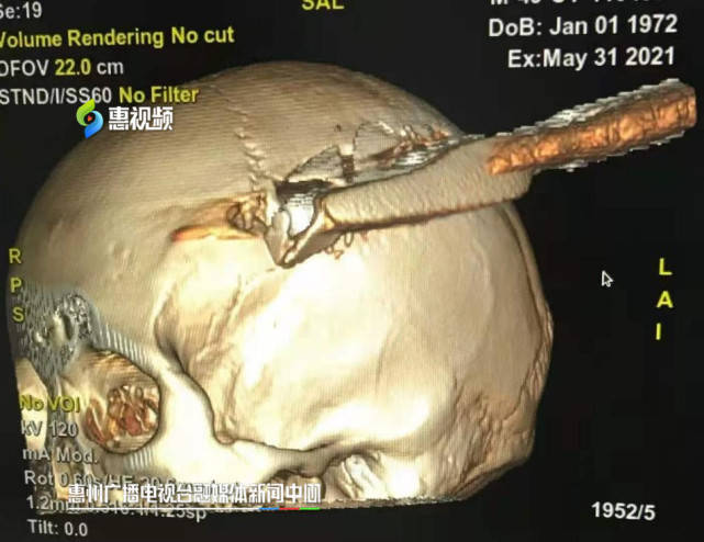 惊险!高空坠落钢筋直插工友头颅 医生妙手开颅取物救回一条生命