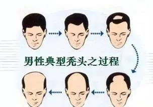 头发|不想内卷，远离脱发！选工作时一定要避开这5个职业！