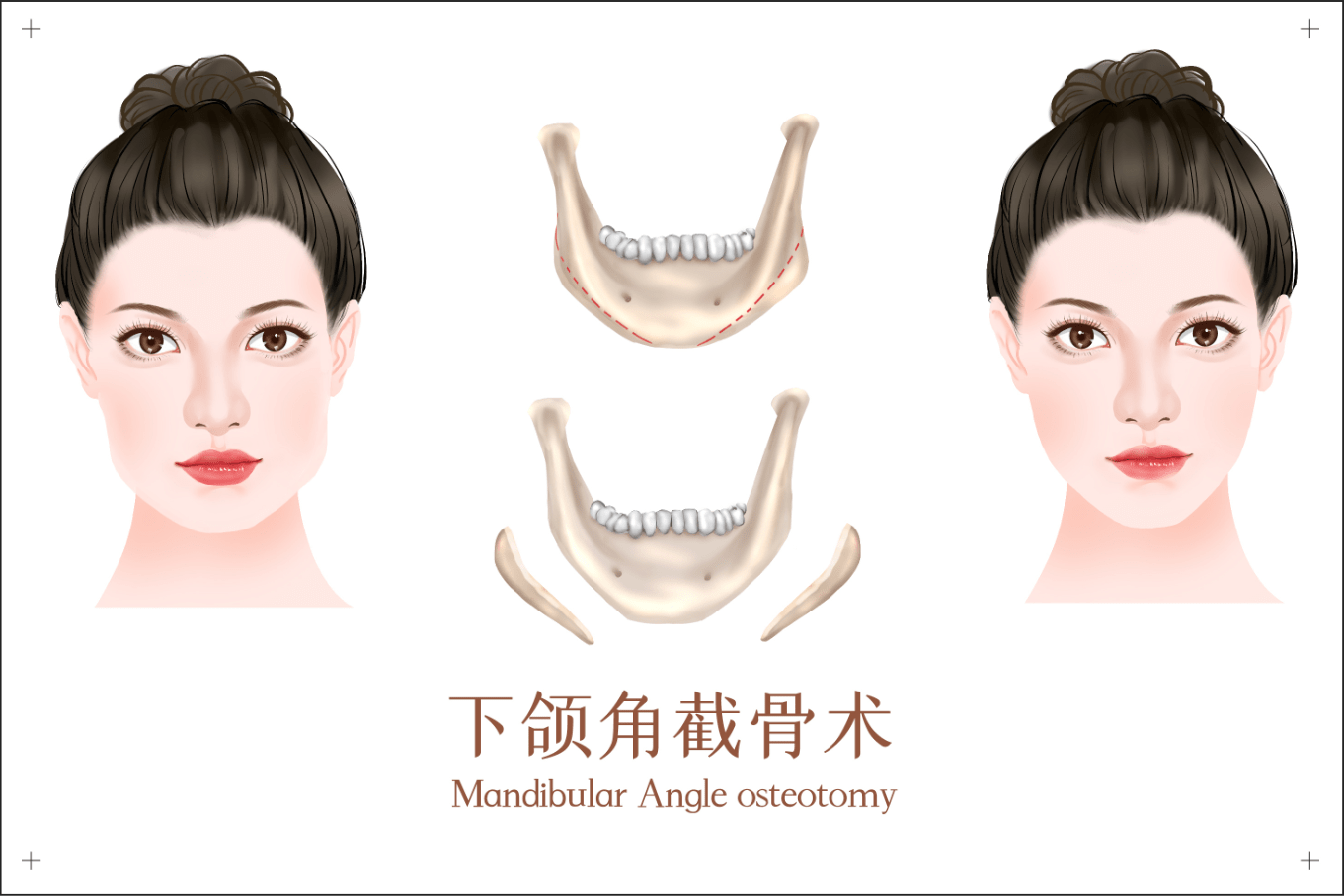 方脸变成瓜子脸下颌角肥大截骨手术