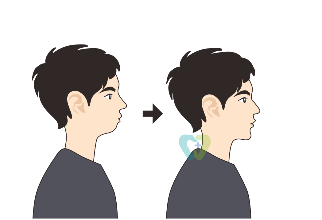 咬合|笑起来满嘴都是牙？你不知道的“微笑颊廊”是get元气感笑容的关键