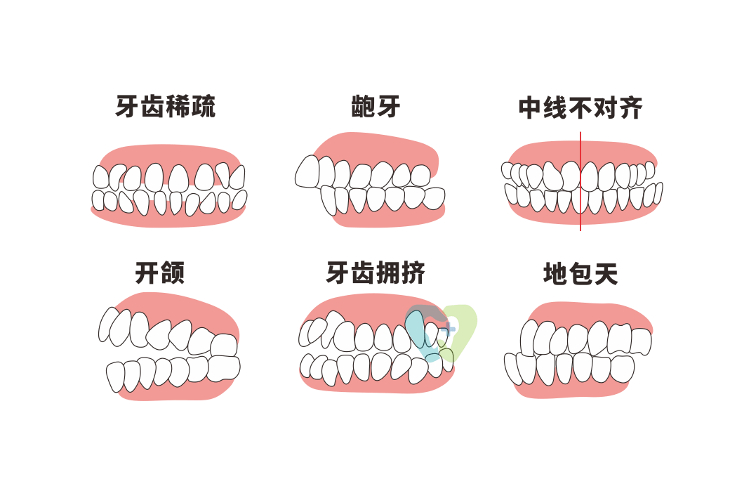 咬合|笑起来满嘴都是牙？你不知道的“微笑颊廊”是get元气感笑容的关键