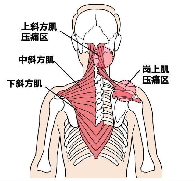 肩颈各个部位疼痛图解图片