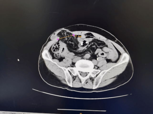 術前ct提示:腹壁切口疝,部分小腸疝出,右側腹股溝疝.