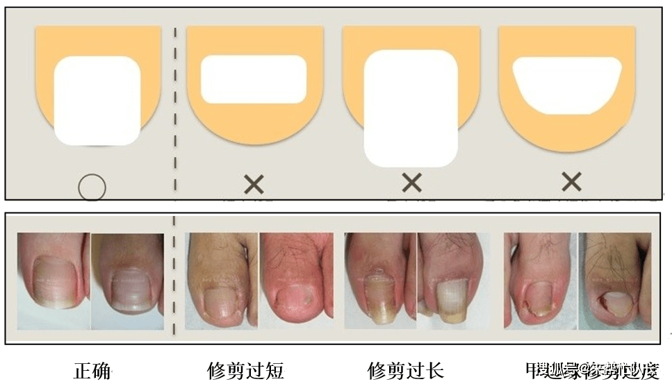 得了指甲炎怎么办