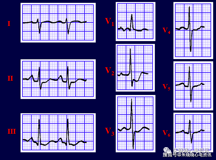 這6種常見心電圖你一定要學會!_心室