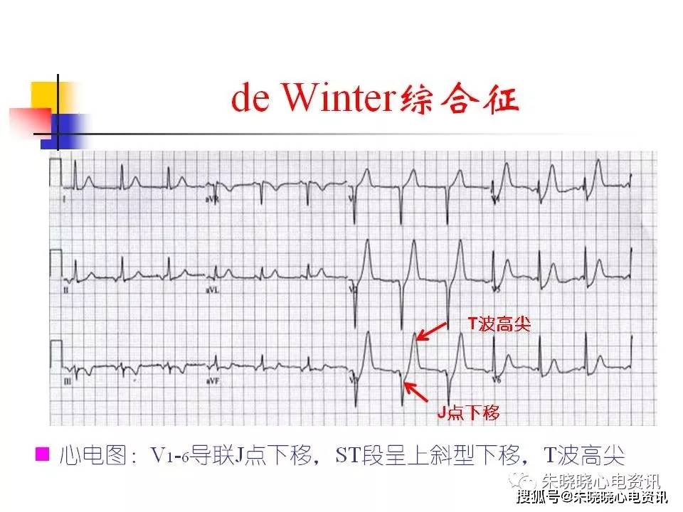 心电图危急值识别与处理ppt
