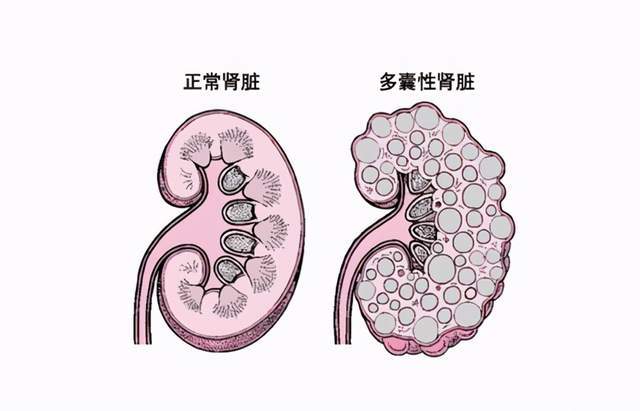 多囊腎不是不治之症囊腫可以縮小腎友們加油