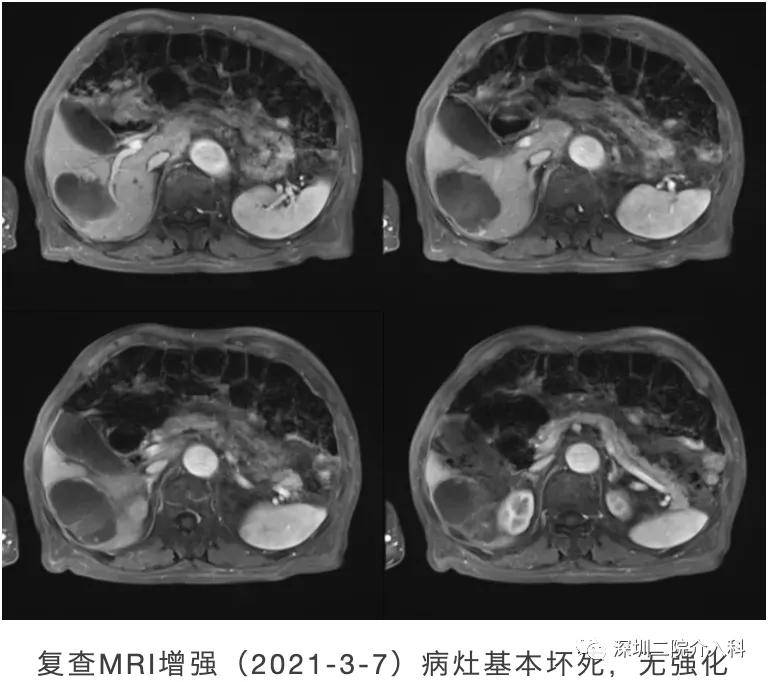 患者|高龄患者得肝癌就要放弃治疗？介入医生说“NO”！