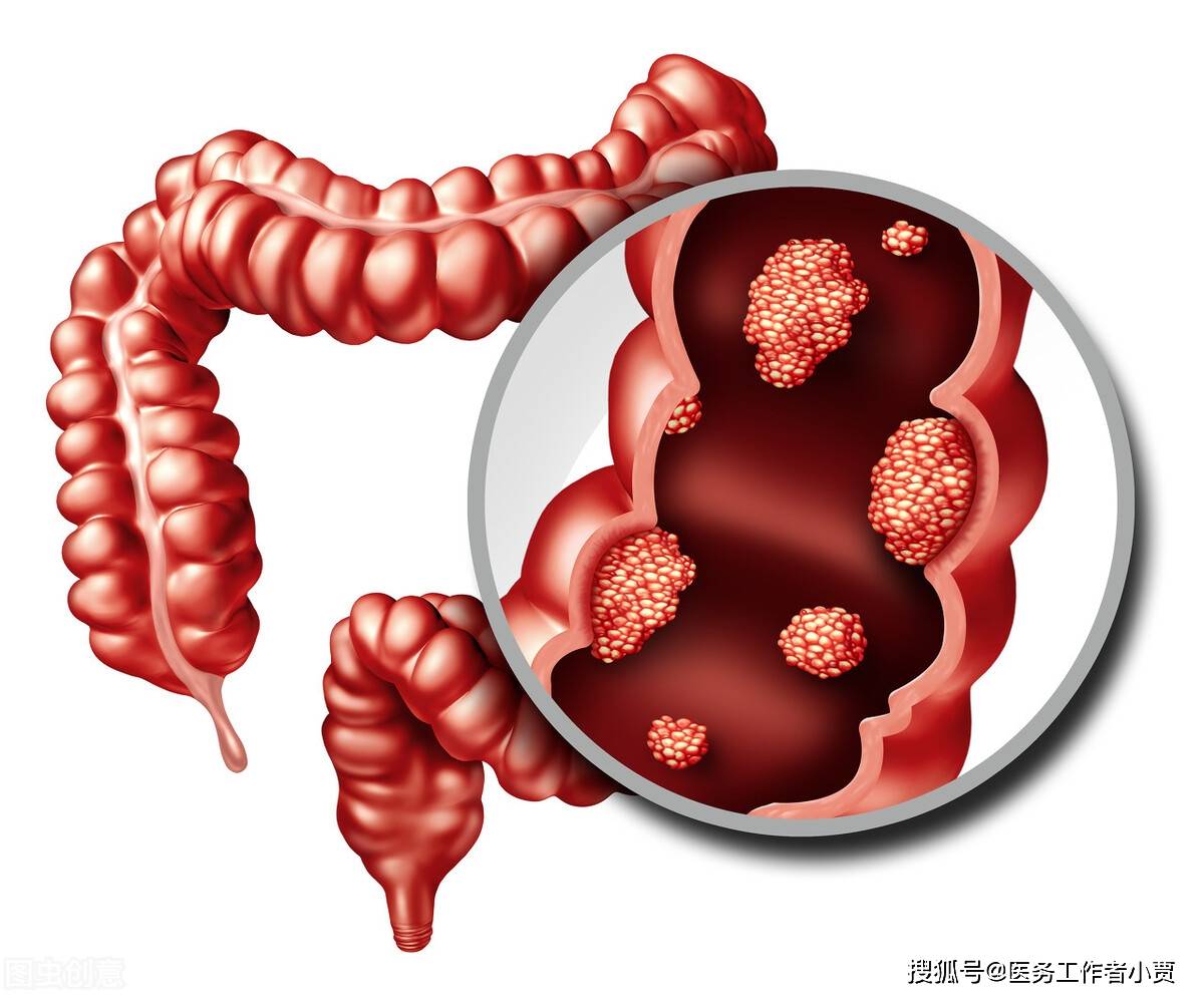 大腸直腸癌多用微創手術治療 精準麻醉讓病人肌肉舒緩 安全性大增且術後恢復較快 照護線上 健康遠見