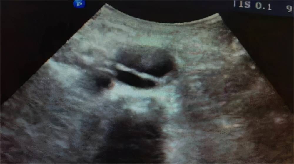 夹层|真性动脉瘤、假性动脉瘤、夹层动脉瘤特点及表现