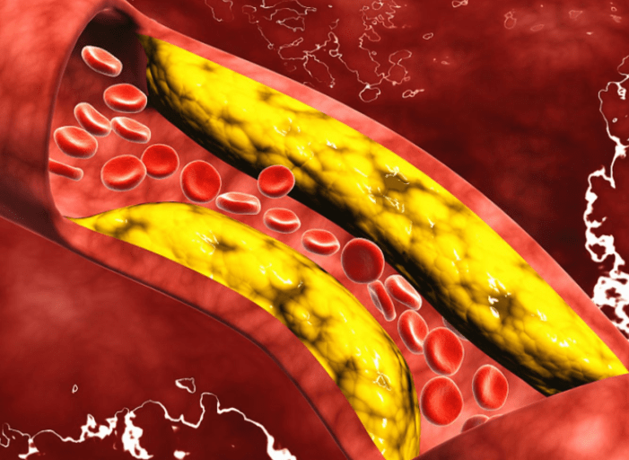 血管堵有"信号",夜间睡觉若常出现3点变化,建议趁早去查脑ct