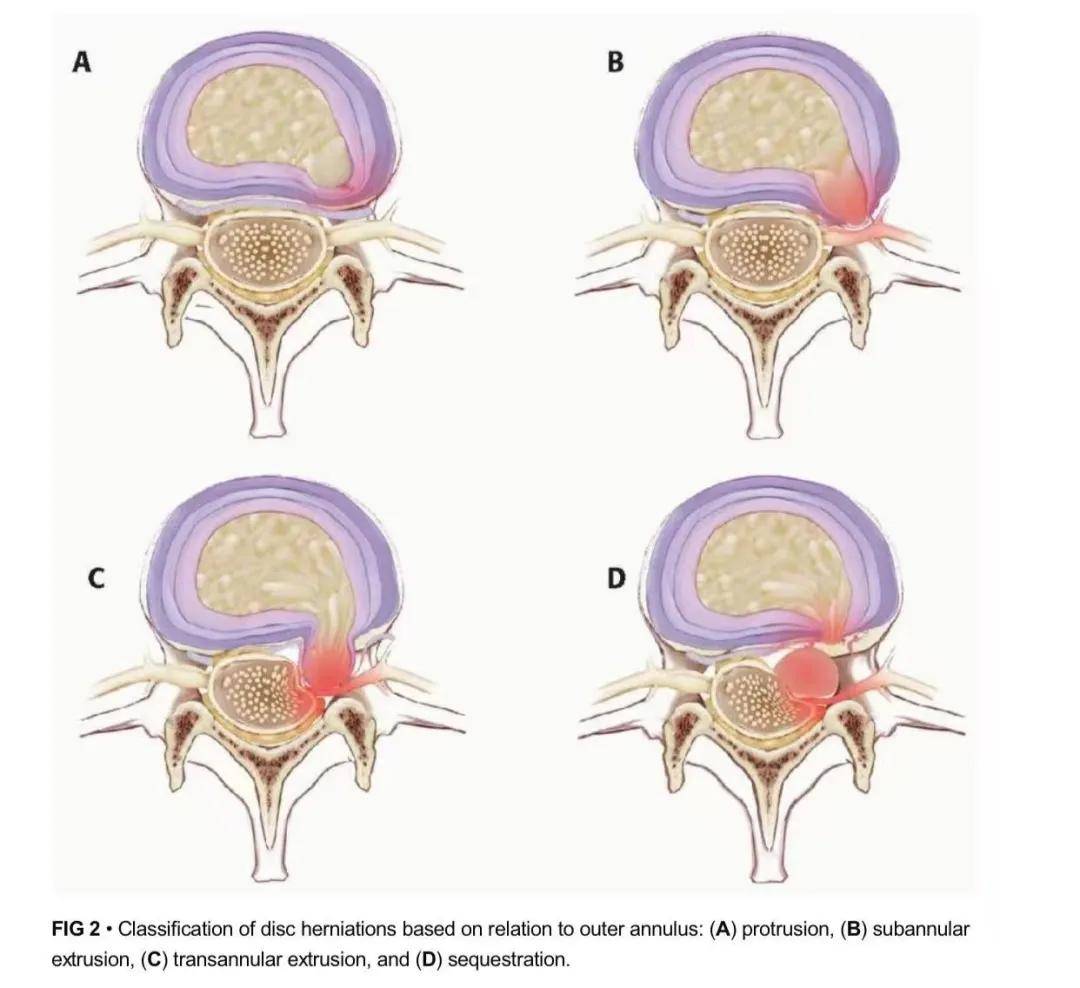 科普|脊柱科普丨腿痛？可能是腰出现了问题！