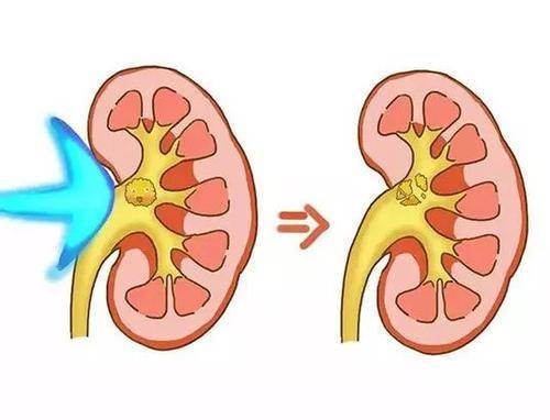 肾脏|得了肾结石，去年打了一次，现在还能再打？医生给您一次性说清楚