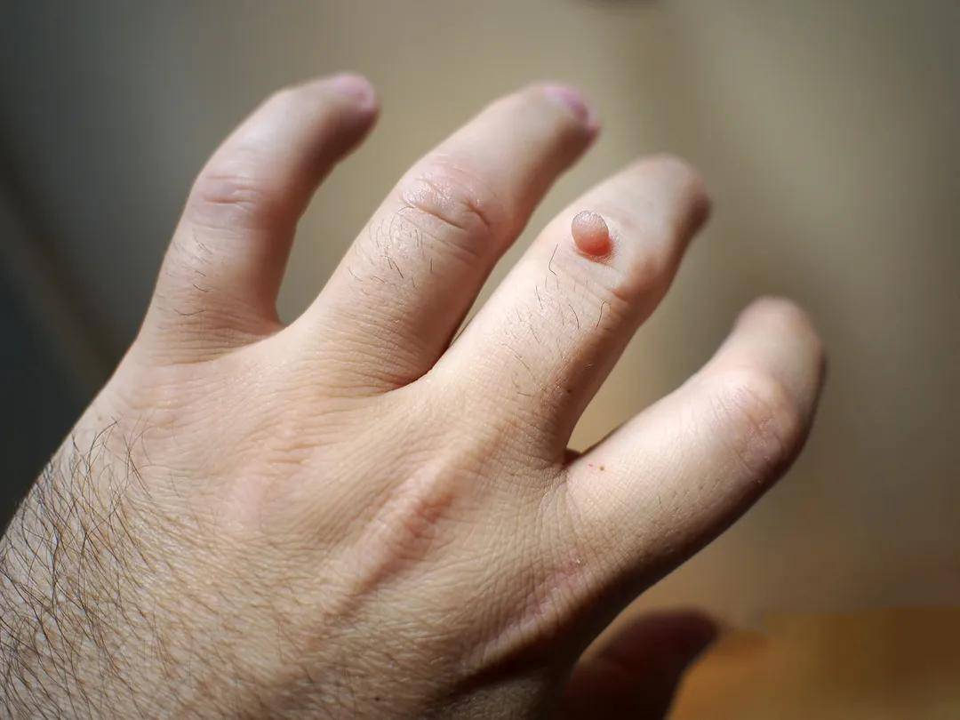 病毒|身上的瘊子是感染HPV，一个动作就会传给孩子！家里有娃的赶快看