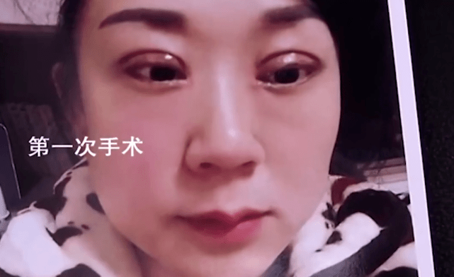 割双眼皮医院排行_江西一女子割双眼皮称像怪物,老公闹着要离婚,美容医院拒绝退费