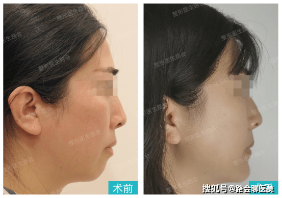 下巴|假体垫下巴嘴唇会变薄吗？