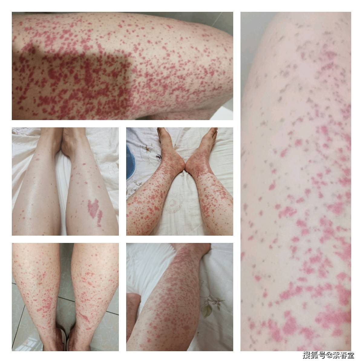 过敏性紫癜肾炎必须做肾穿吗化验检查尿蛋白转阴怎么回事