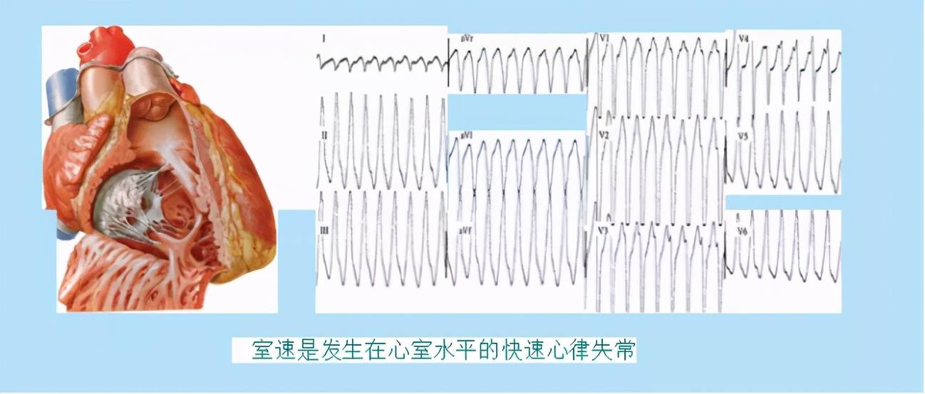 静脉|【一“心”只为您“健”康】“室上速”有效治疗手段：电生理检查和射频消融术