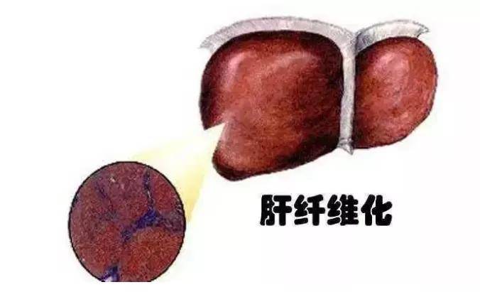 症状|“肝纤维化”和“肝硬化”傻傻分不清？肝纤维化能否逆转？