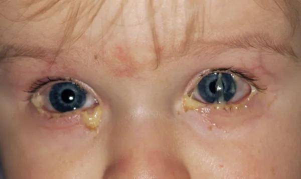 宝宝红眼病的症状图片图片