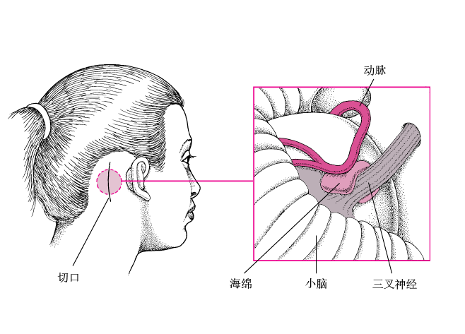 止痛药|震惊！折磨67岁老太太四年的牙痛 背后的真凶竟然是...