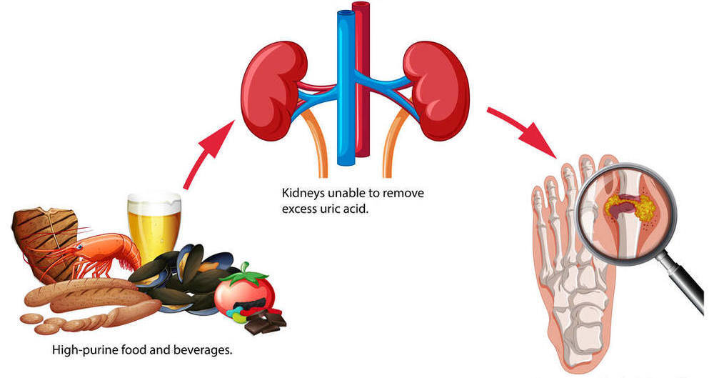 尿酸|都说要多喝水，但多喝水真的好吗？