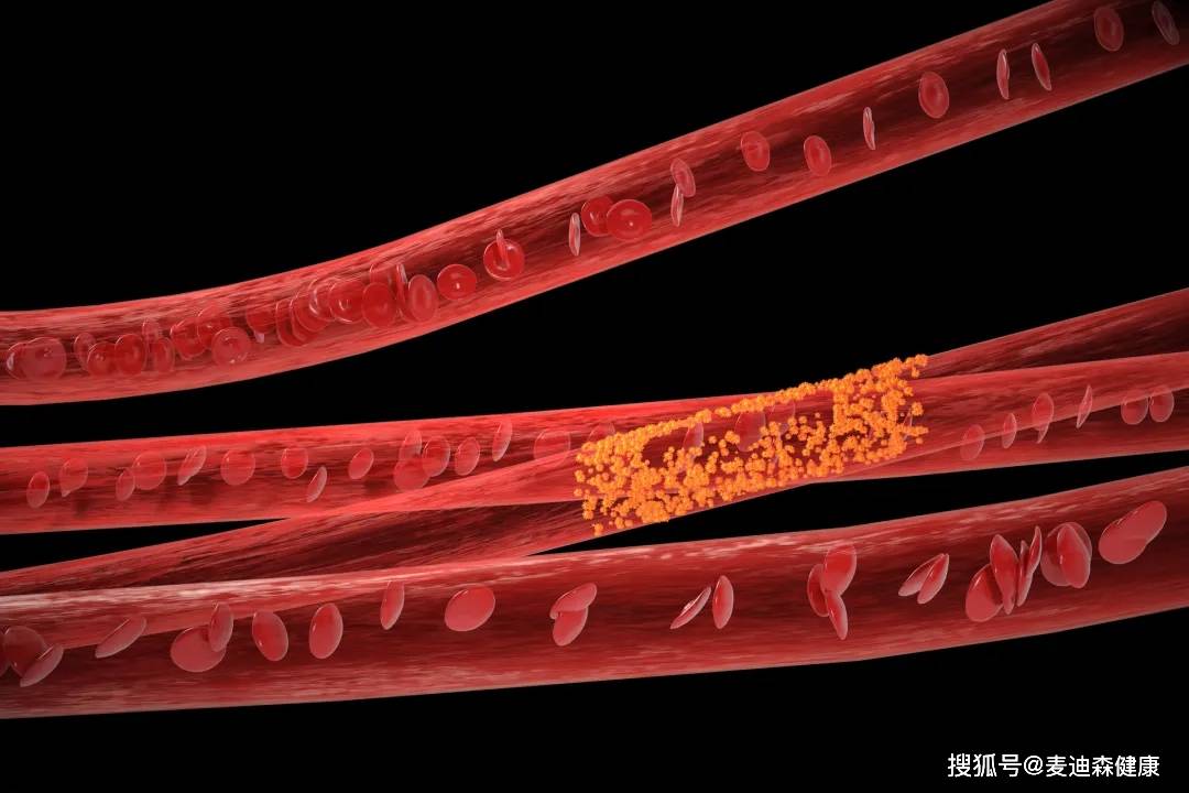 控制|麦迪森健康科普:常见的动脉瘤有几种?如何预防动脉瘤?