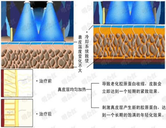 玛吉|热玛吉原理及作用，25岁才知道热玛吉也不算迟