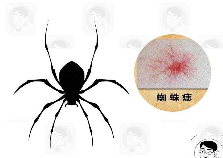 肝脏|肝病不能早期发现?身体出现“2红1黄”,警惕疾病中晚期