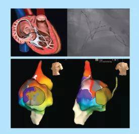 频率|【一“心”只为您“健”康】心房扑动患者，要尽早治疗！