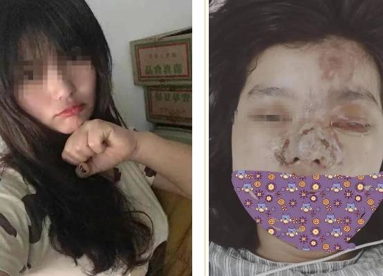 眼睛|悲剧！滑县妙龄女子微整形致眼睛失明！这种“小手术”好多人都在做