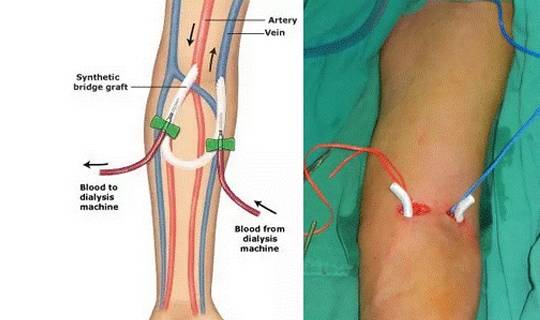 生存时间|血透患者照样可以长寿,除了管住嘴,这几项也缺一不可!