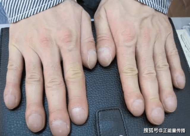 症状|肺部病变，身体先知！身体出现这几个“症状”，别不当回事