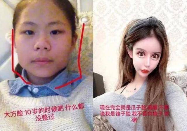 13岁女孩“整容上瘾”3年整了60多次如今“画风”不忍直视(图7)