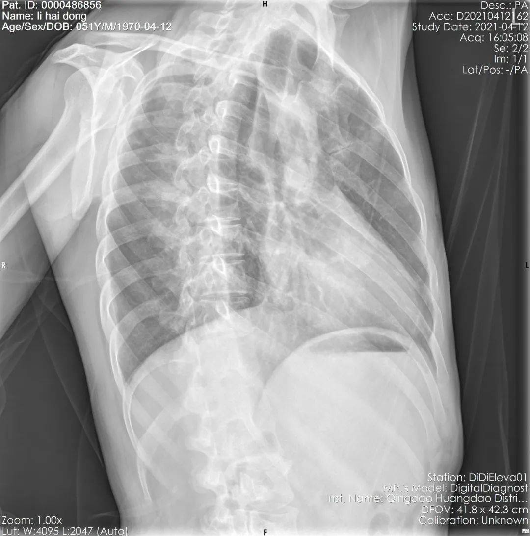 胸外科成功开展Matrix RIB肋骨骨折内固定术_患者