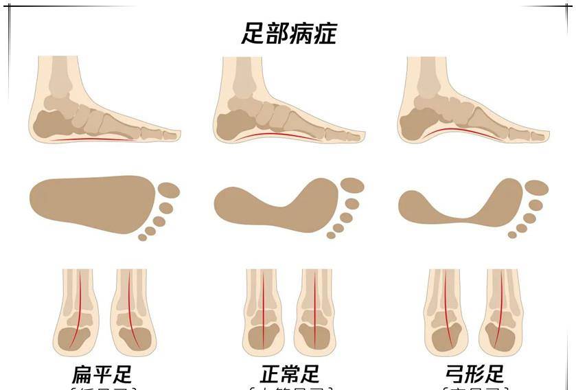 小孩子扁平足是什么样子 8f01dcaf8db14383a7850649268994e7.jpeg