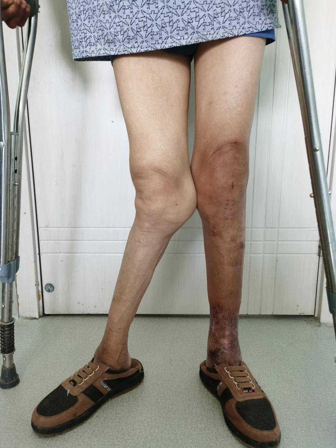 手术|西安市红会医院阎良院区双膝关节置换术圆了甘肃患者“行走梦”