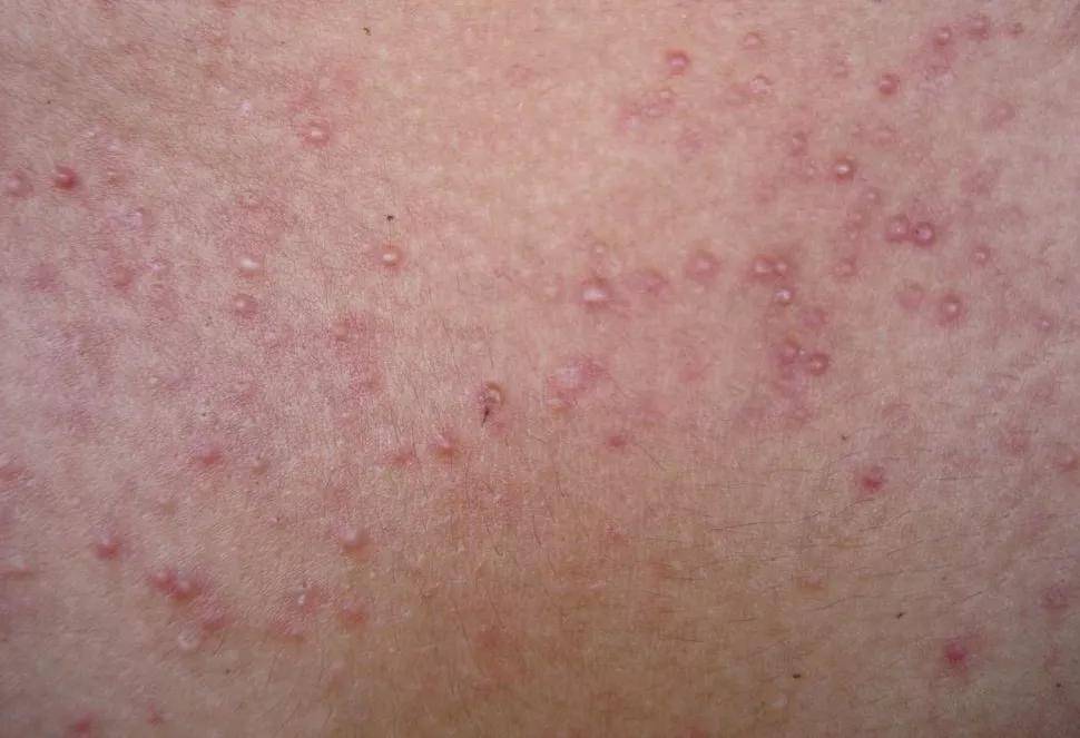 毛囊炎做好这5大护理措施好得快