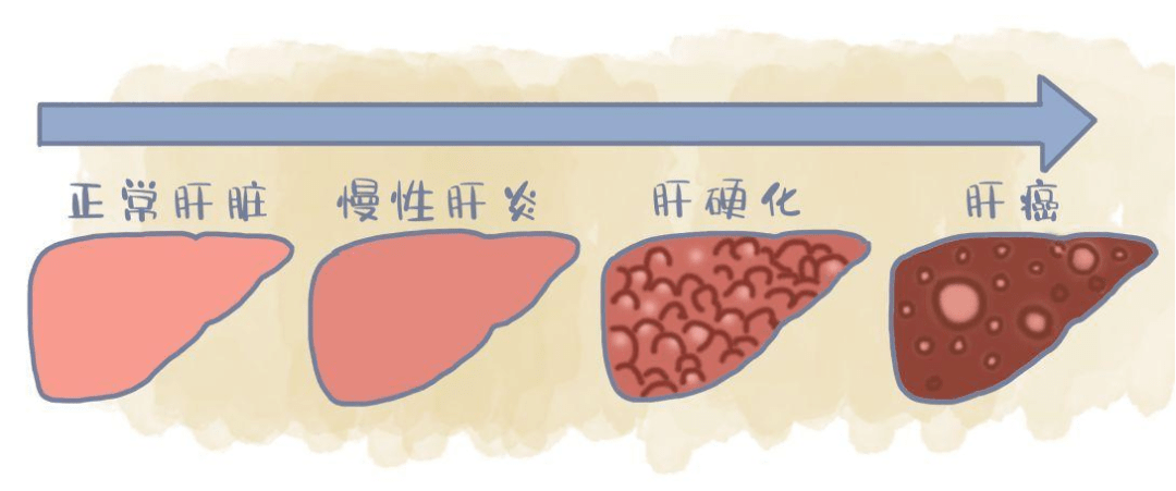 肝癌是什么原因引起的图片