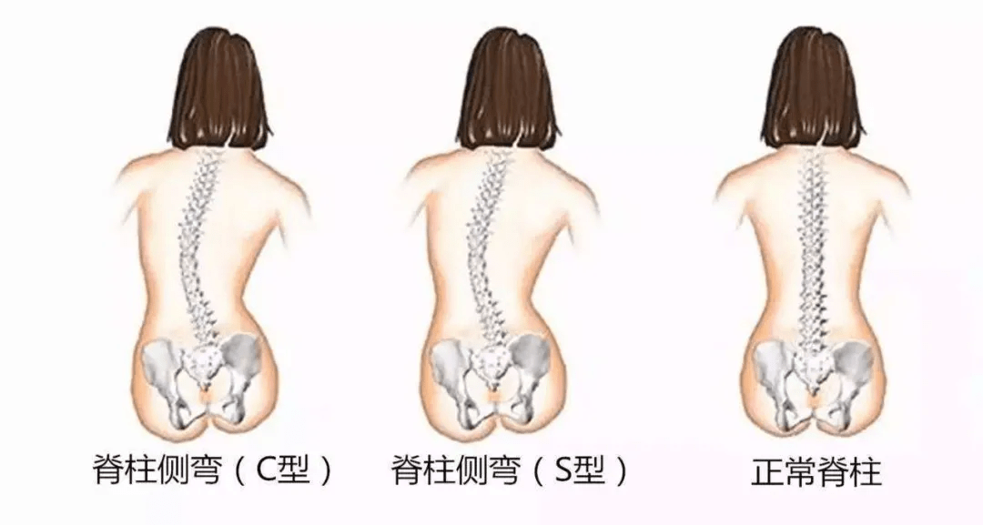 程度|脊柱侧弯危害多，100个人就有3个中招！教你一招来判断