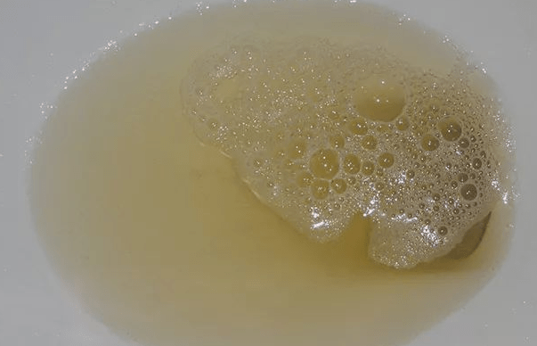 毒素|排尿时发现这4个“蹊跷”,可能是肝脏发出的求救信号,别忽视