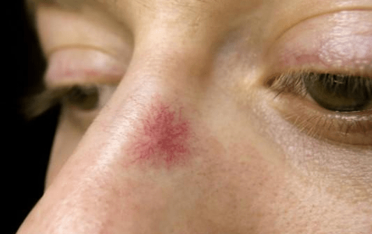 肝脏|口臭可能是肝不好？医生：肝不好有4个表现，对号入座看你占几个