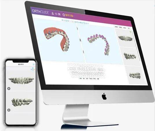 汕头|固定矫正也能看3D效果，数字化正畸导航系统了解一下