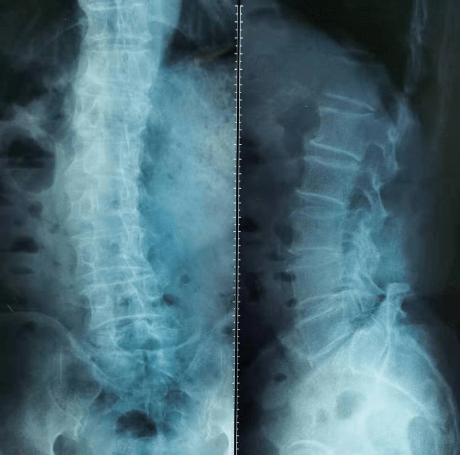 腰椎间盘|我就是擦个地 这腰怎么就坏了？