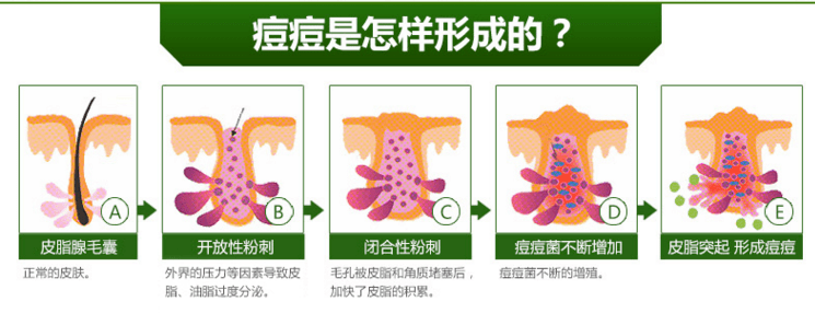 肠道|反复长痘,你护肤的手法正确吗?