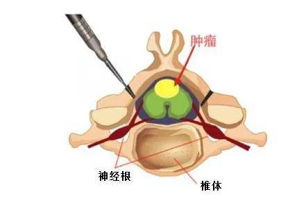 肿瘤|钟情于广场舞的张大妈，因为它，出门只能坐轮椅代步！