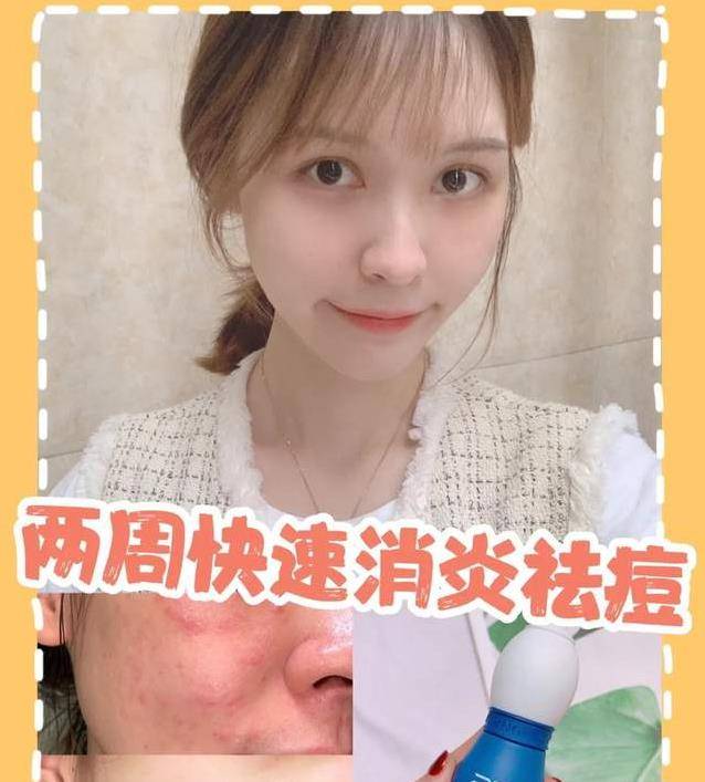 祛痘|粉刺没了、痘痘走了,冬日这几招,能让你脸变得白净又光滑