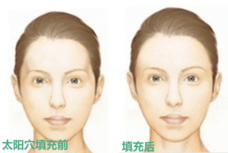 眉骨|给赵露思换了天使大宝贝的眉骨和眼眶骨，这张脸洋气指数飙升120%